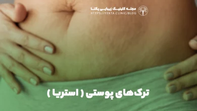 ترک‌های پوستی ( استریا )