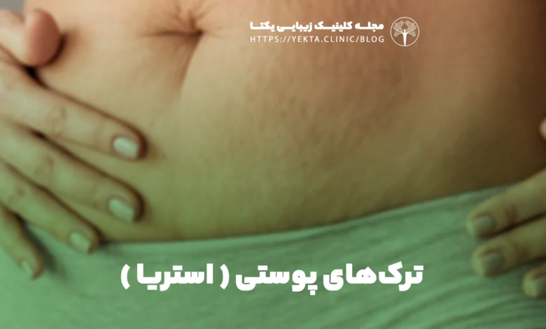 ترک‌های پوستی ( استریا )