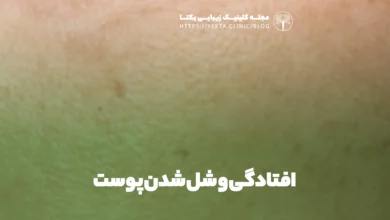 افتادگی و شل شدن پوست