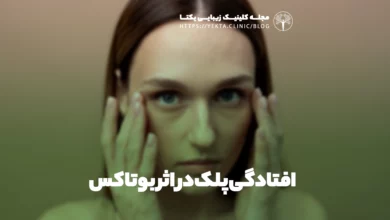 افتادگی پلک در اثر بوتاکس