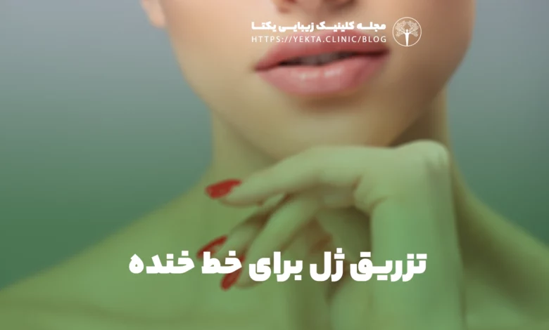 تزریق ژل برای خط خنده