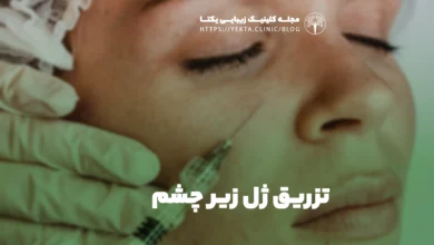 تزریق ژل زیر چشم