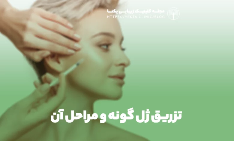 تزریق ژل گونه و مراحل آن
