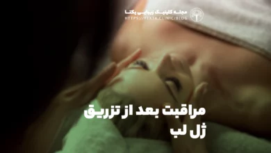 مراقبت بعد از تزریق ژل لب