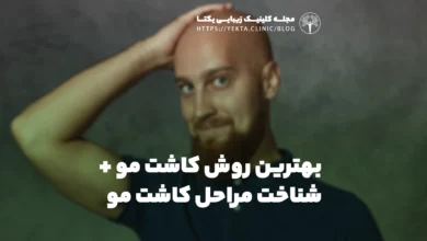 بهترین روش کاشت مو + شناخت مراحل کاشت مو