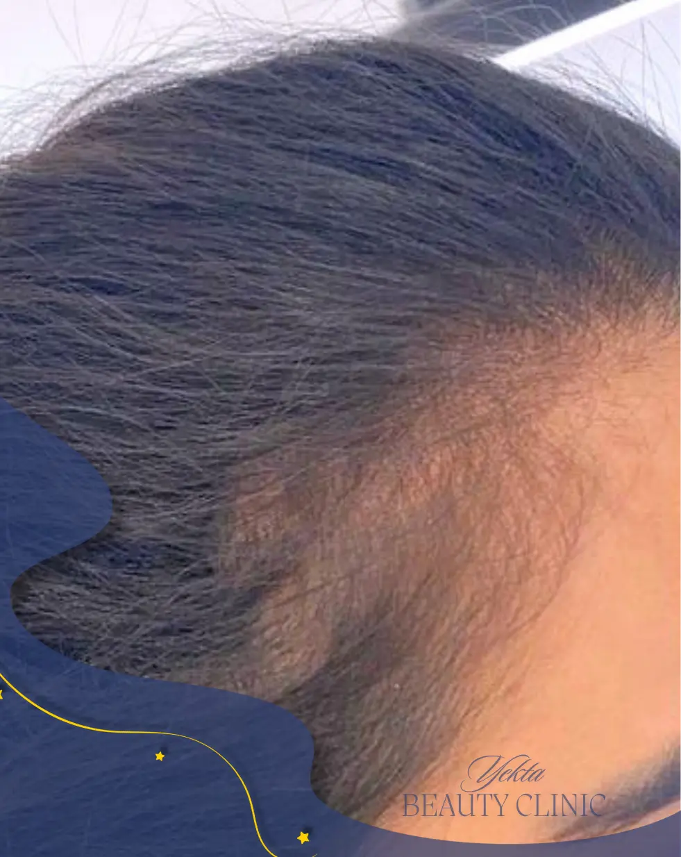 بعد مزوتراپی ۳ بعد مزوتراپی 3