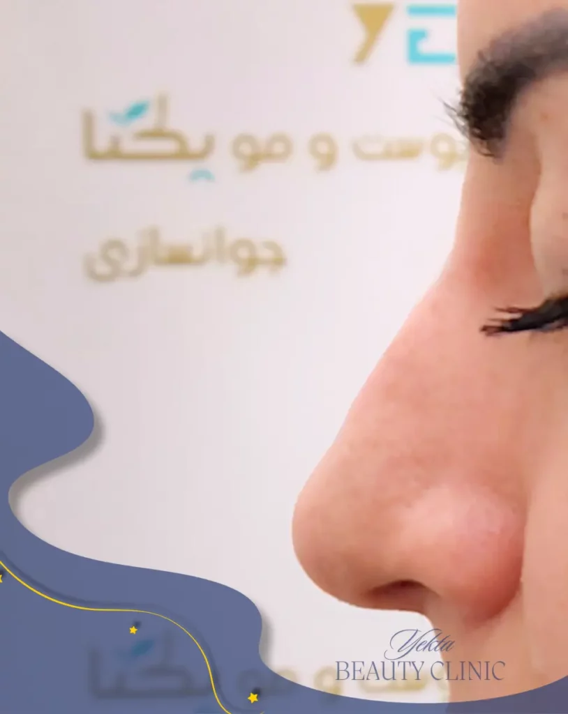 قبل فیلر بینی قبل
