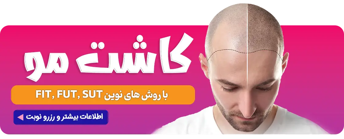 کاشت مو، کاشت ابرو، کاشت ریش و سبیل