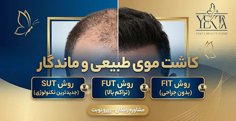 کاشت مو، بزرگترین مرکز کاشت موی ایران، کاشت مو در پیروزی، بهترین مرکز کاشت مو در پیروزی،