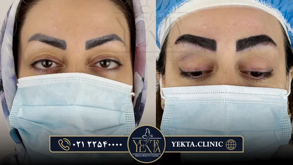 کاشت ابرو،کاشت ابرو طبیعی،