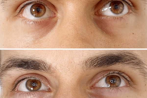 فیلر زیر چشم برای چه کسانی مناسب است؟ 35 فیلر برای چه کسانی مفید است