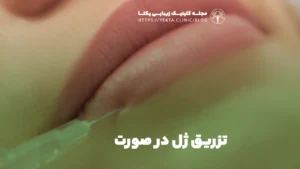 تزریق ژل در صورت
