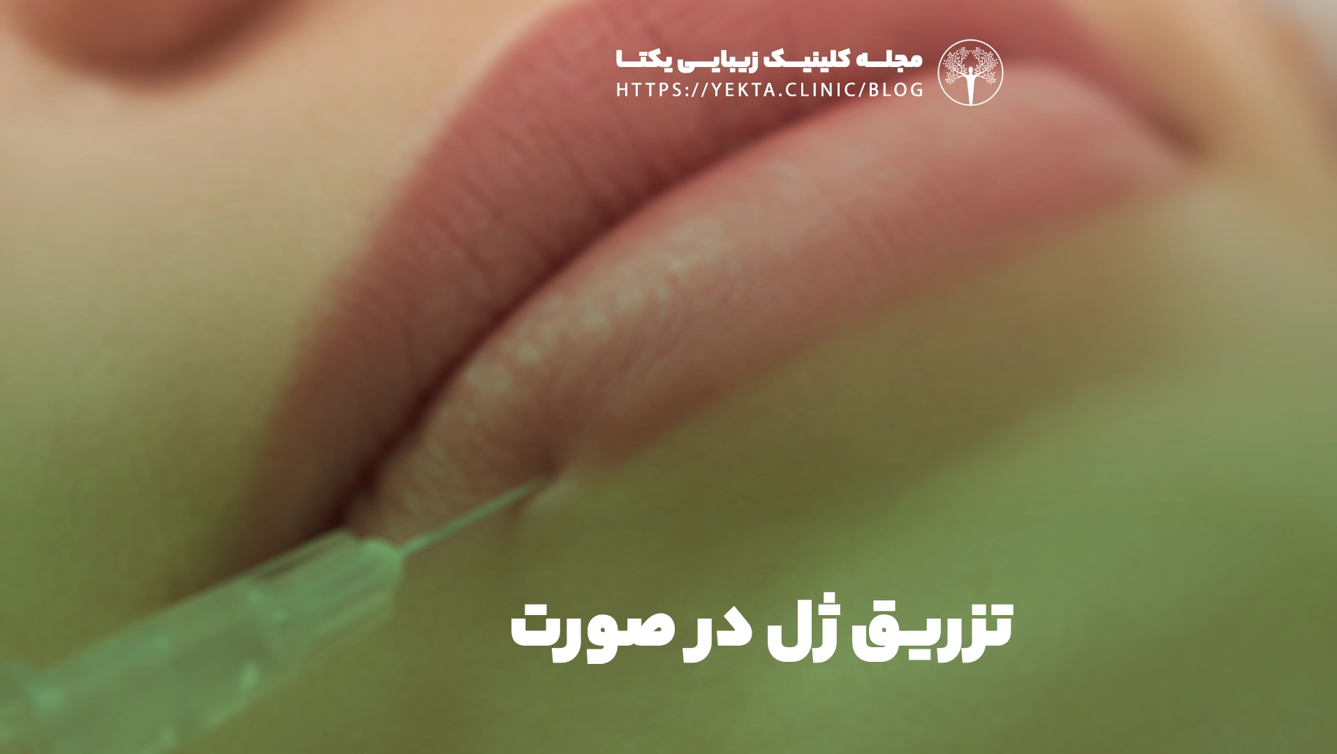 تزریق ژل در صورت