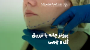 پروتز چانه با تزریق ژل و چربی