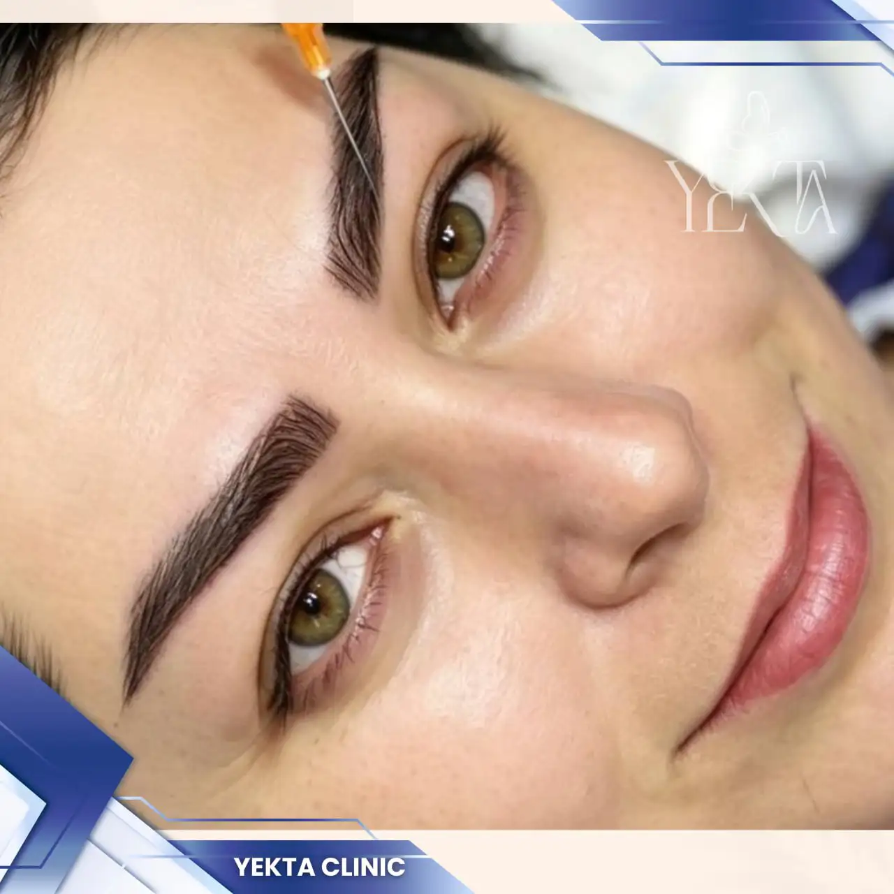 کاشت ابرو، کاشت ابرو پیروزی، کاشت ابرو طبیعی،