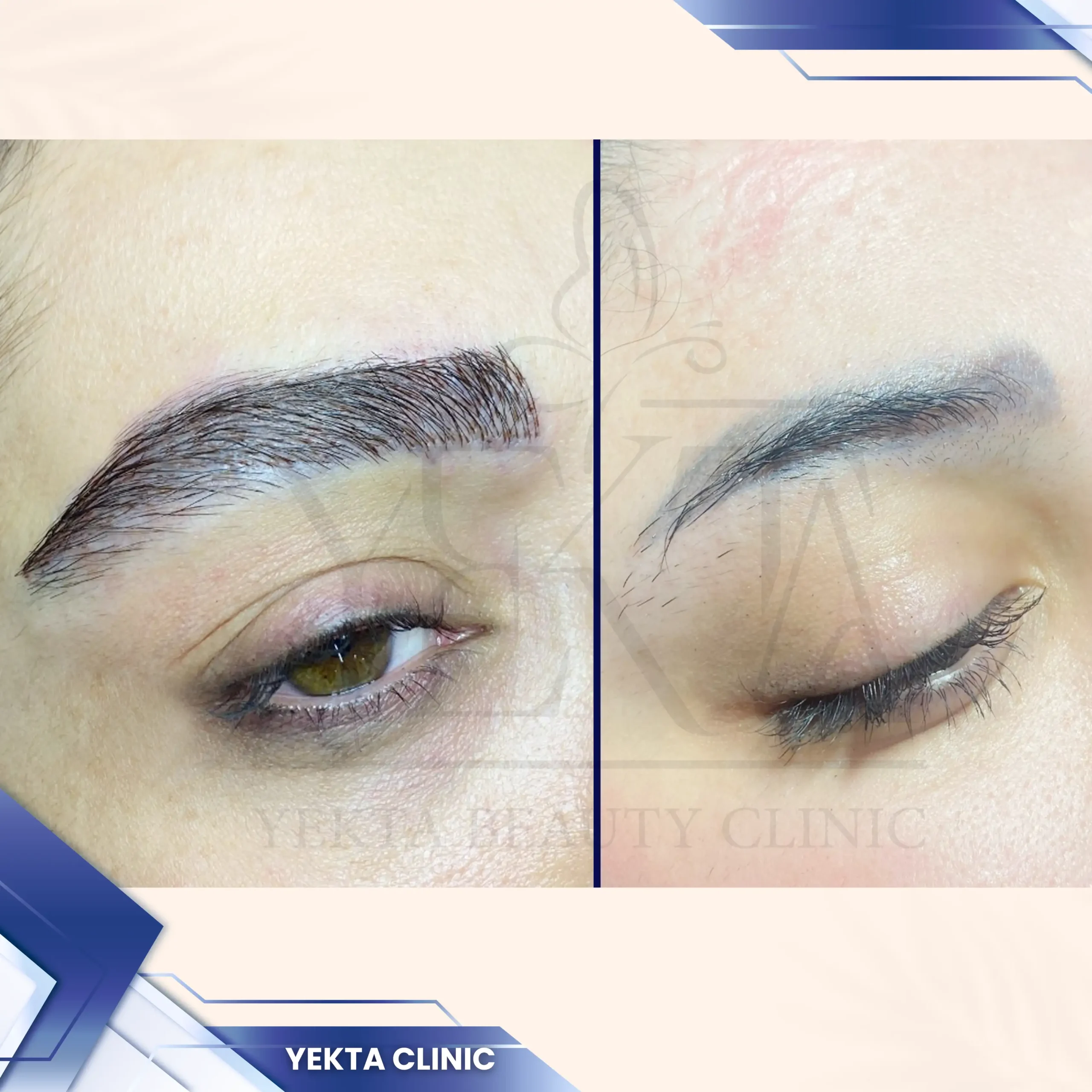 کاشت ابرو، کاشت ابرو پیروزی، کاشت ابرو طبیعی،