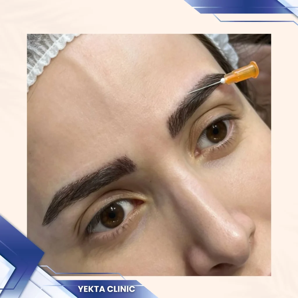 کاشت ابرو، کاشت ابرو پیروزی، کاشت ابرو طبیعی،