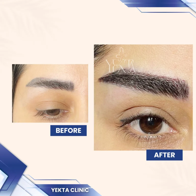 کاشت ابرو، کاشت ابرو پیروزی، کاشت ابرو طبیعی،