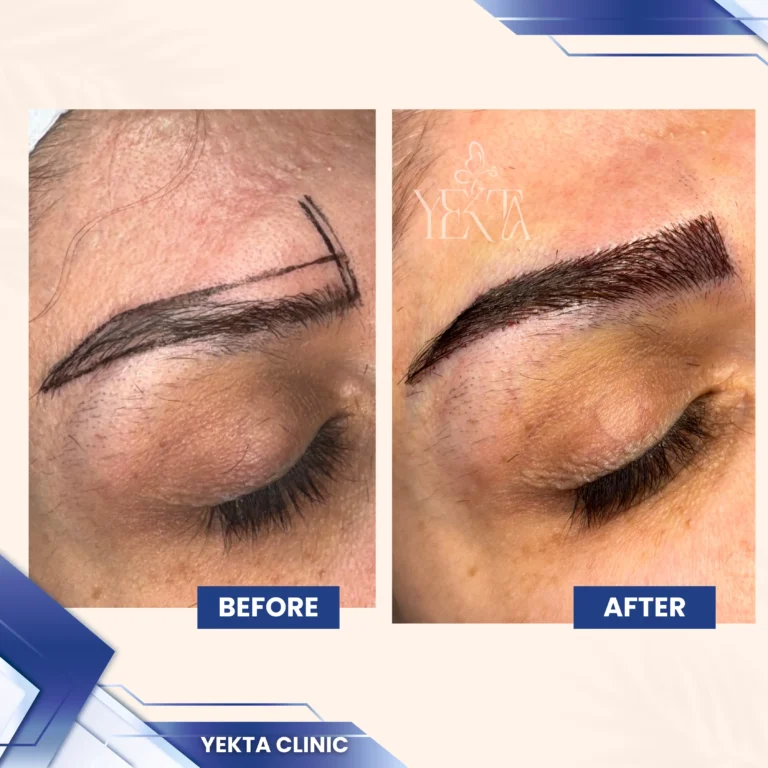 کاشت ابرو، کاشت ابرو پیروزی، کاشت ابرو طبیعی،