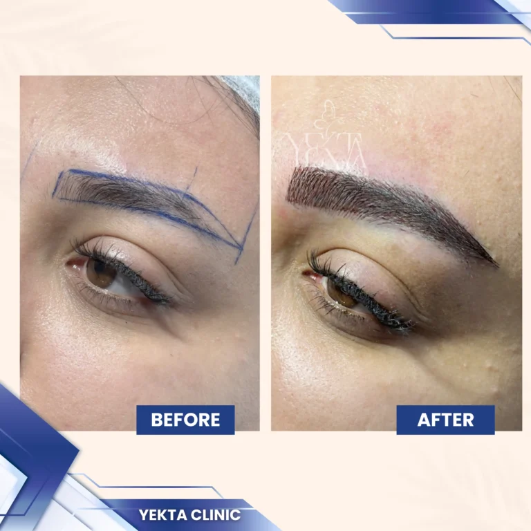 کاشت ابرو، کاشت ابرو پیروزی، کاشت ابرو طبیعی،