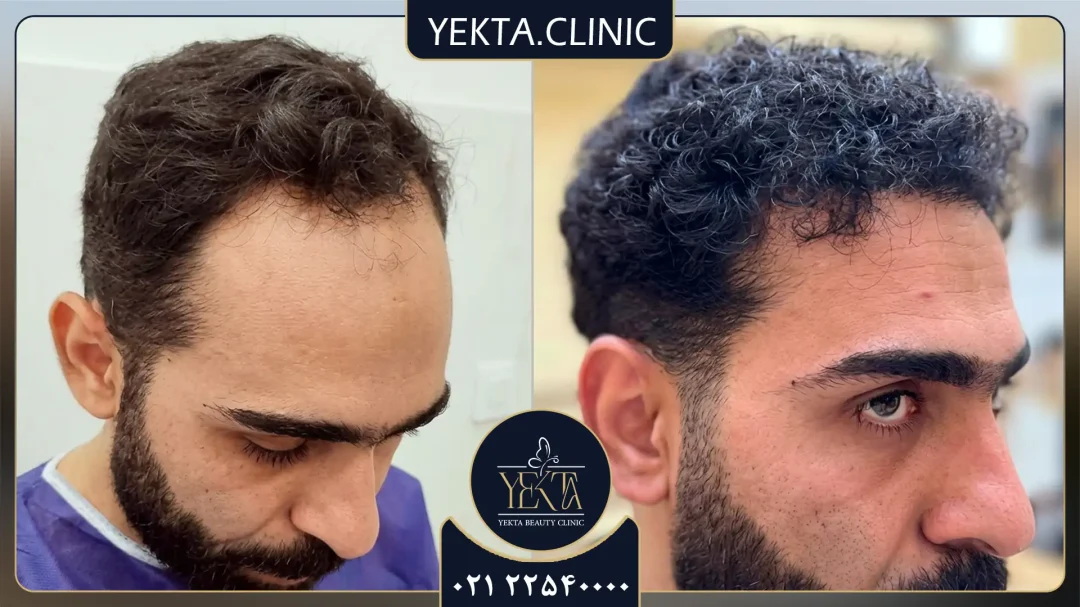 کاشت مو، کاشت مو یکتا، کاشت مو پیروزی